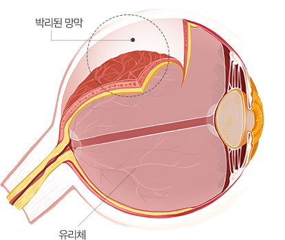 박리된 망막과 유리체
